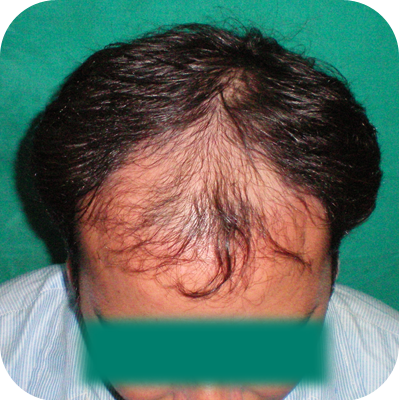 mega hair transplant delhi
