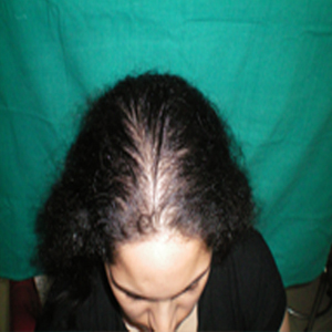 Female Hair Loss Treatment in Delhi 