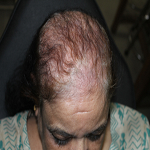 Androgenetic alopecia 