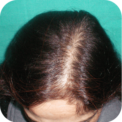 hair Problem treatment