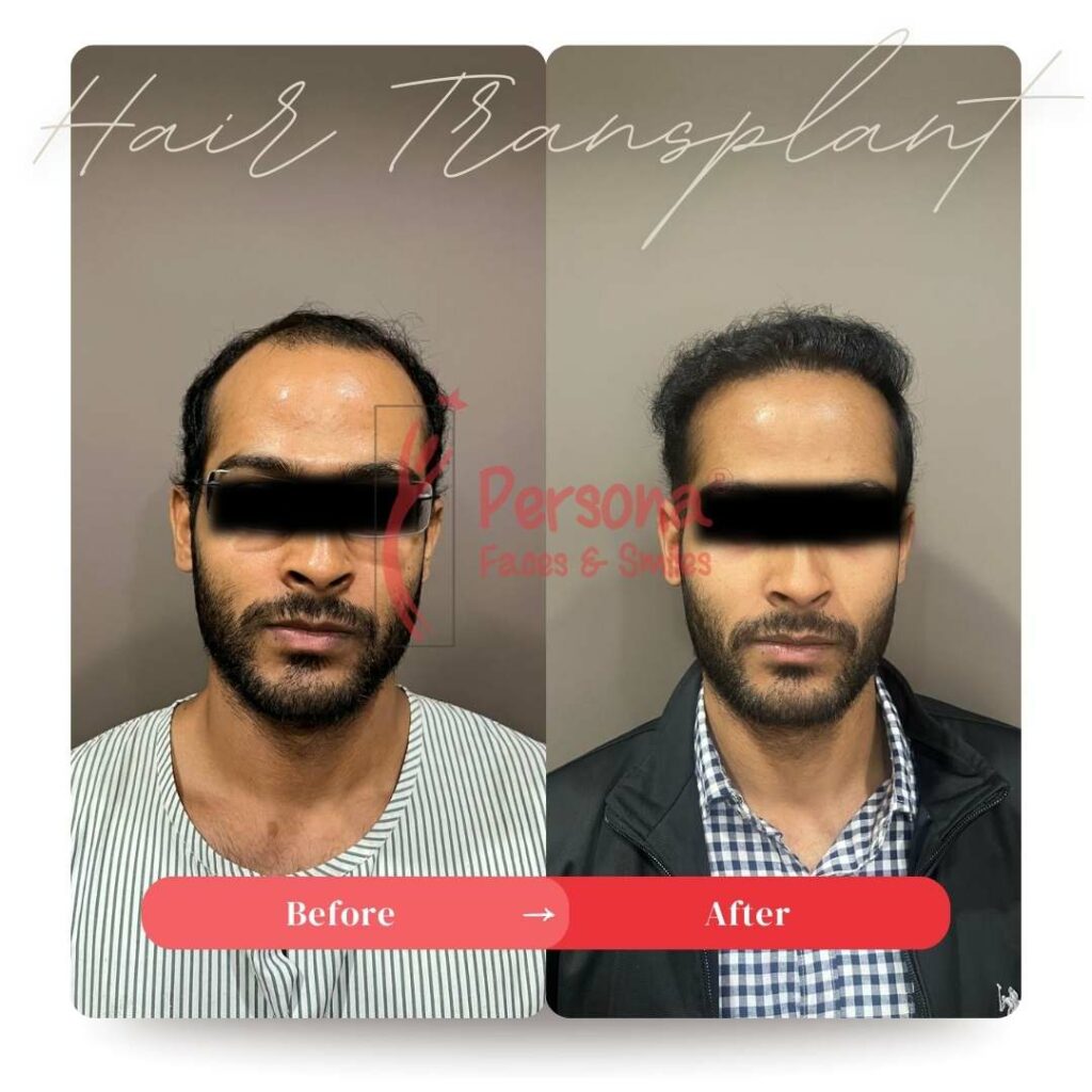 Hair Transplant Result 1