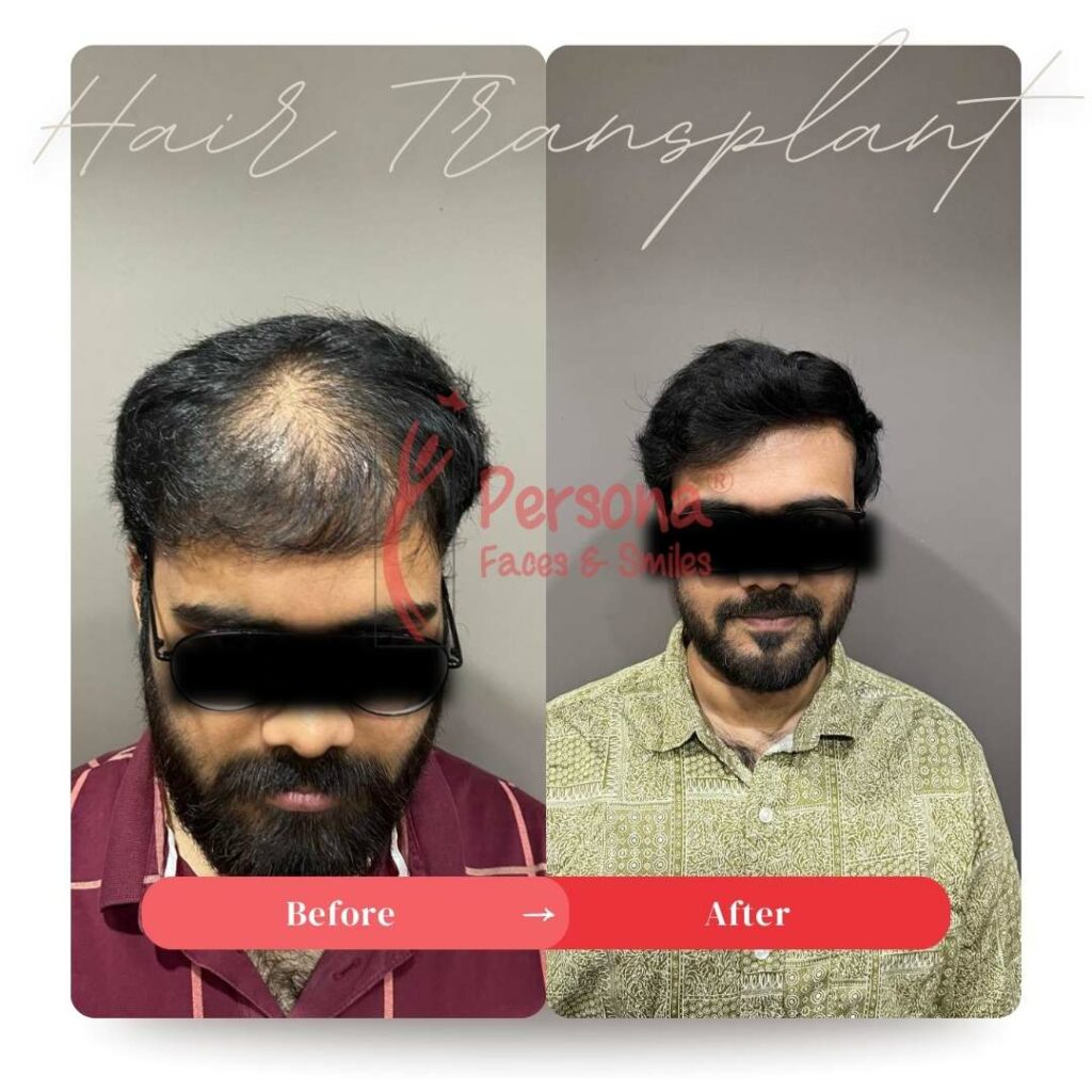 Hair Transplant Result 2