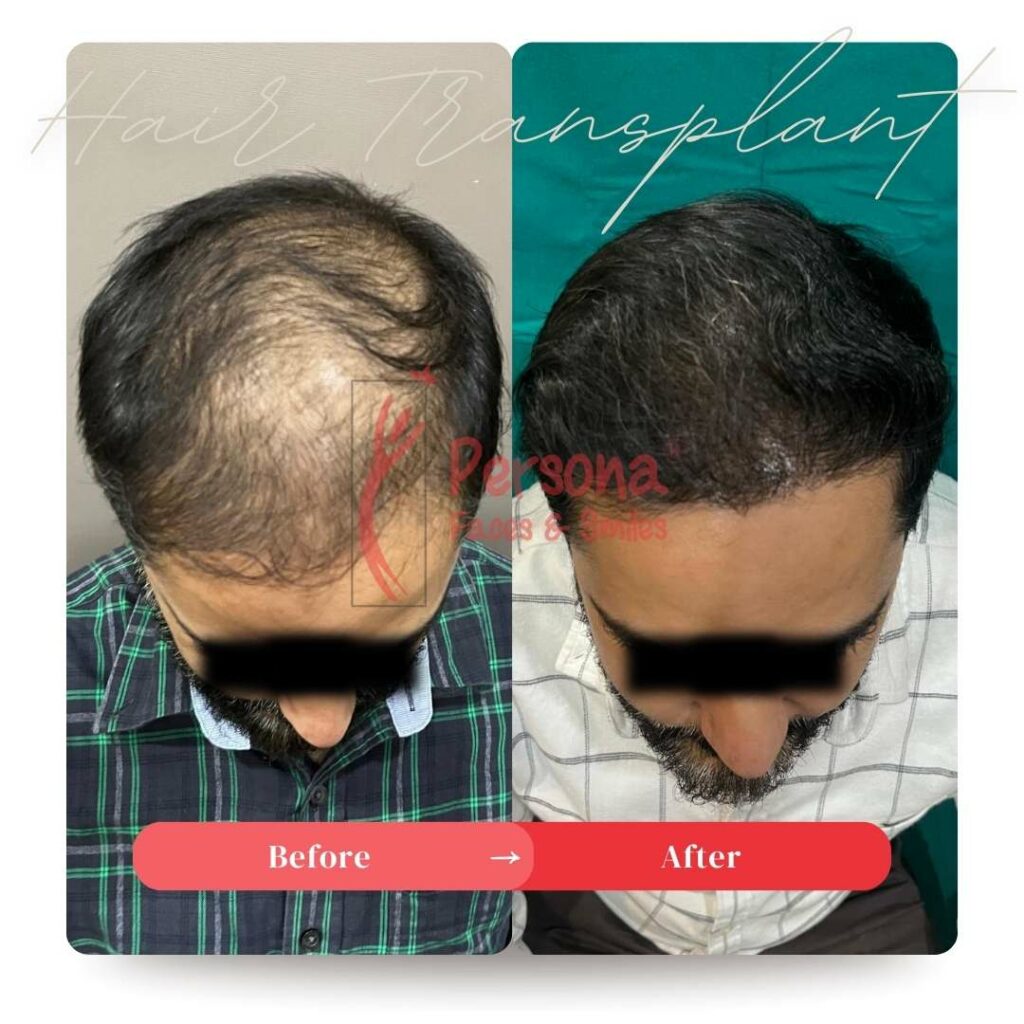 Hair Transplant Result 3