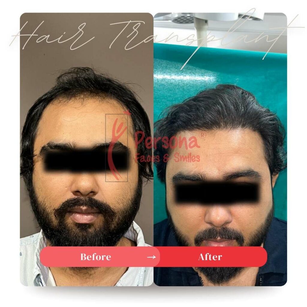 Hair Transplant Result 4