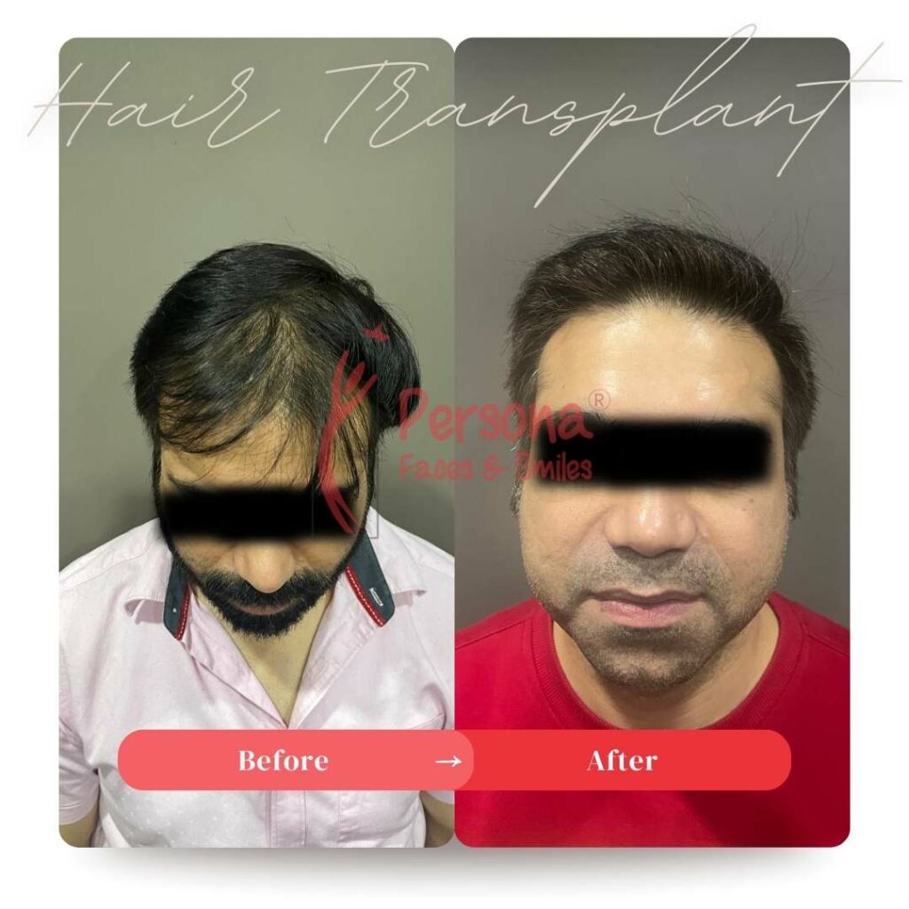 Hair Transplant Result 5