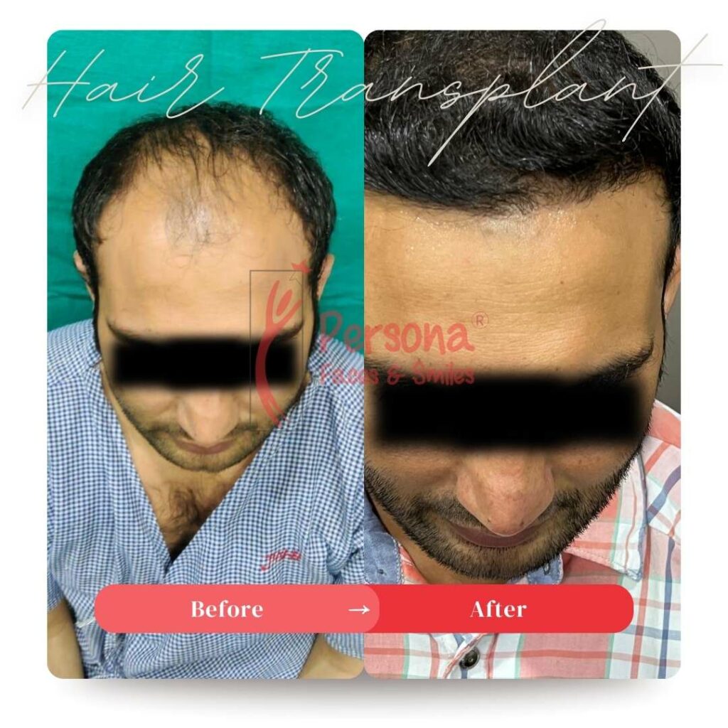 Hair Transplant Result 6