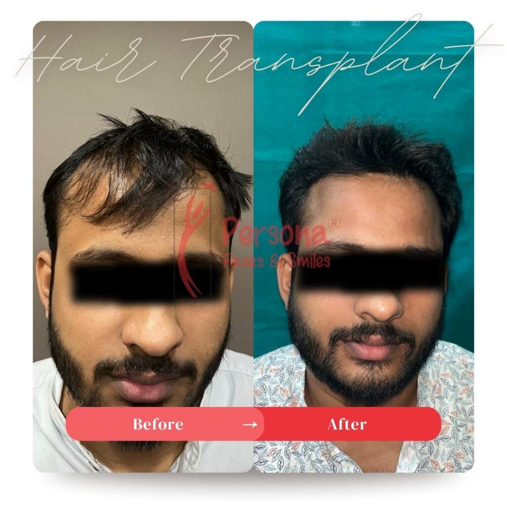 Hair Transplant Result 7