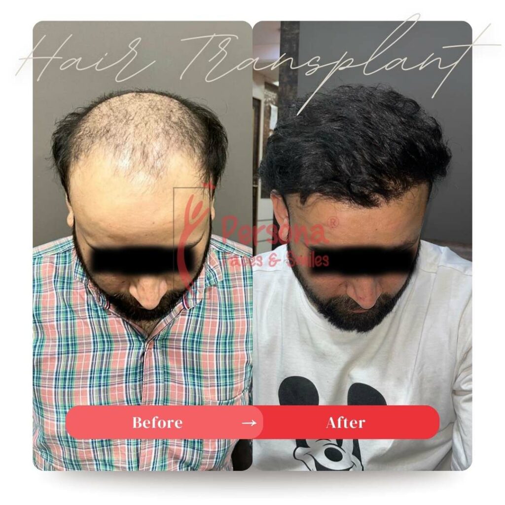 Hair Transplant Result 8