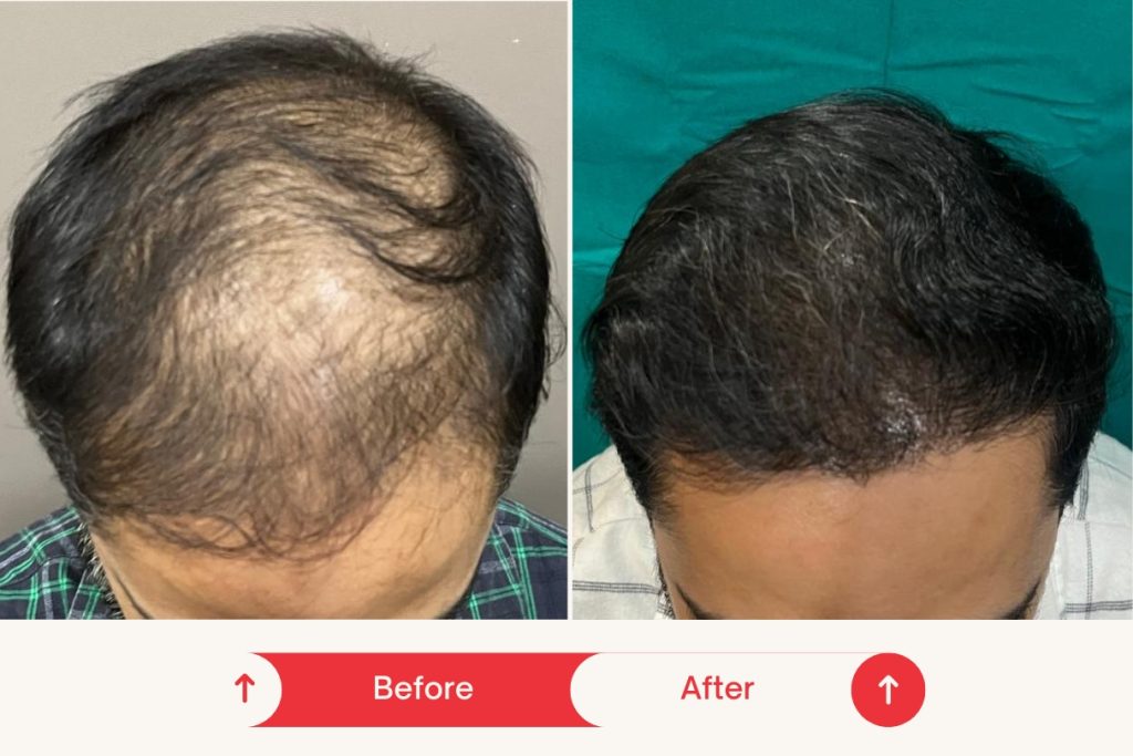 Testimonial Hair Transplant 1