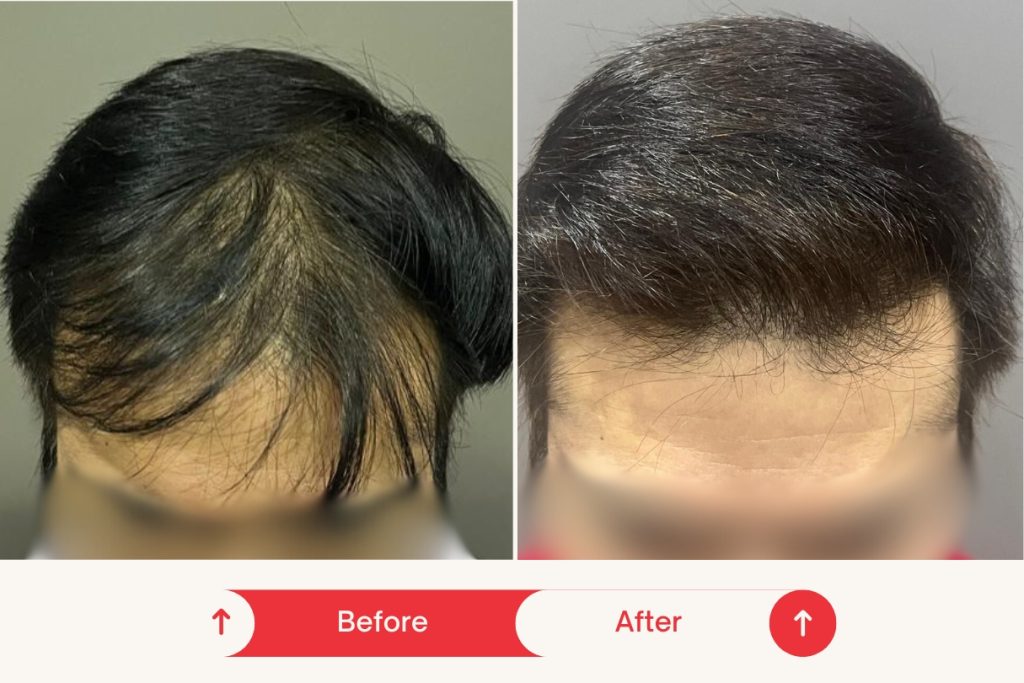 Testimonial Hair Transplant 2