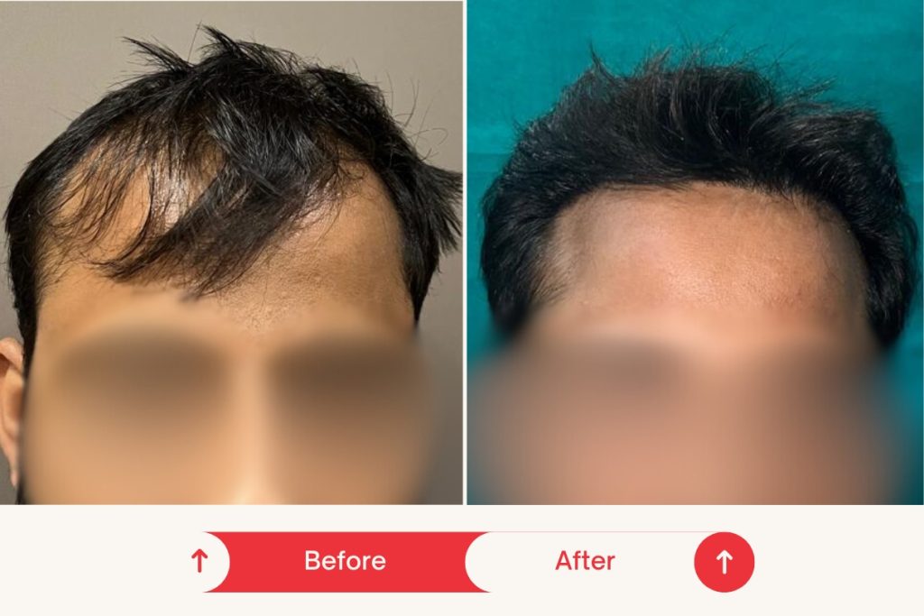 Testimonial Hair Transplant 3