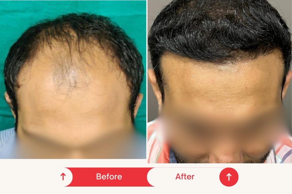 Testimonial Hair Transplant 4