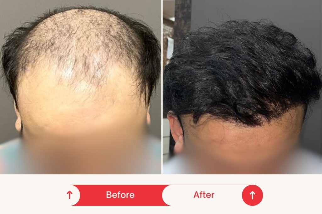 Testimonial Hair Transplant 5