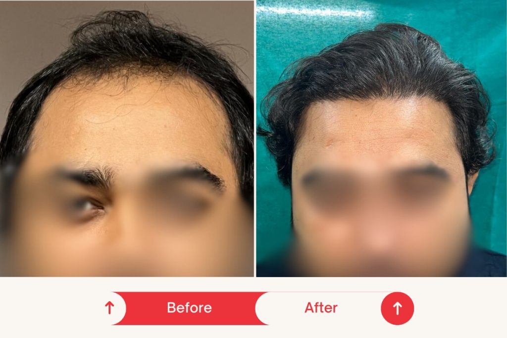 Testimonial Hair Transplant 6