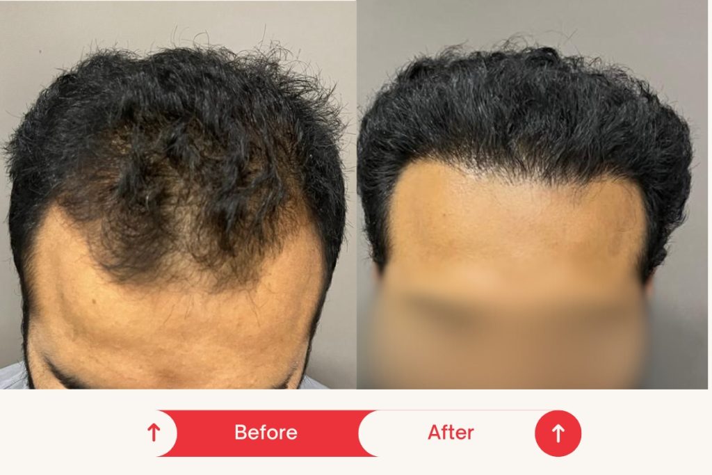 Testimonial Hair Transplant 7